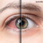 What Is Commonly Misdiagnosed as Pink Eye