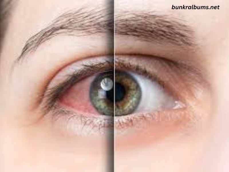 What Is Commonly Misdiagnosed as Pink Eye